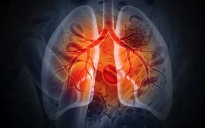 Seeking Alpha: BeyondSpring plinabulin, Merck Keytruda combo shows promise in NSCLC